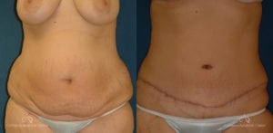 Abdominoplasty Before and After Photos Patient 5C