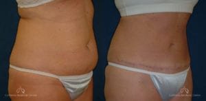 Abdominoplasty Before and After Photos Patient 7B