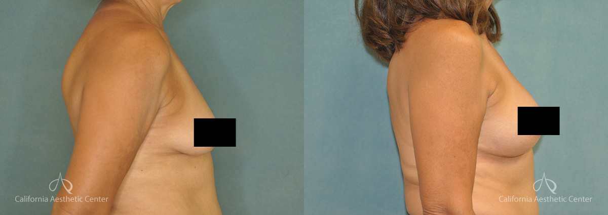 DrVU Breast Augmentation Patient 1a Censored2