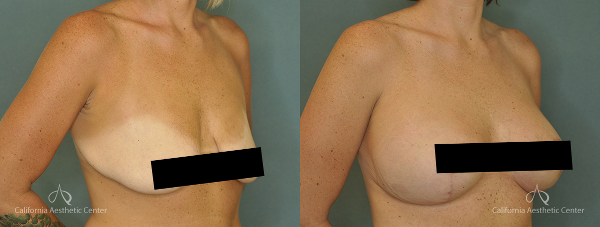 DrVU Breast Lift Patient 1b Censored2