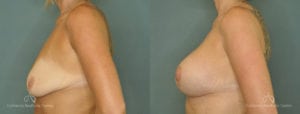 Breast Lift Before and After Photos Patient 1E
