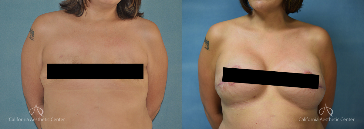 DrVU Breast Reconstruction Patient 1c Censored2