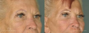 Brow Lift Before and After Photos Patient 1B
