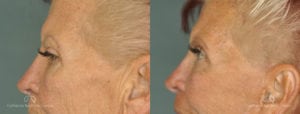 Brow Lift Before and After Photos Patient 1C