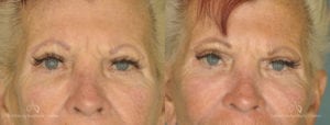 Brow Lift Before and After Photos Patient 1E