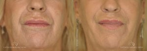 Upper Blepharoplasty Before and After Photos Patient 1C