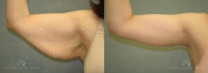 Patient 2 Brachioplasty Before and After Right