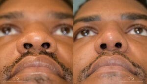 Patient 5 Rhinoplasty Before and After Under