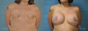 Breast Reconstruction Before and After Photos Patient 1C