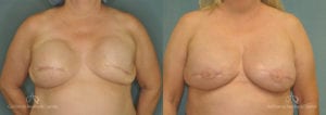 Breast Reconstruction Before and After Photos Patient 2C