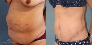 Panniculectomy Before and After Photos Patient 1A