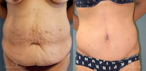 Panniculectomy Before and After Photos Patient 1C