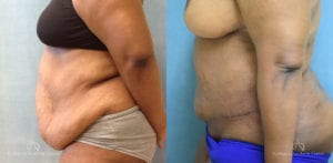 Panniculectomy Before and After Photos Patient 2B