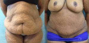 Panniculectomy Before and After Photos Patient 2C