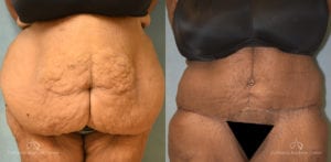Panniculectomy Before and After Photos Patient 3C