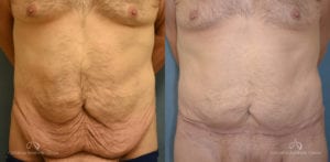 Panniculectomy Before and After Photos Patient 4A