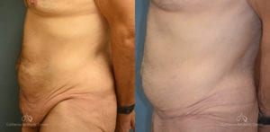 Panniculectomy Before and After Photos Patient 4C