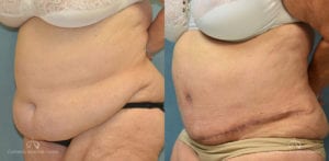 Panniculectomy Before and After Photos Patient 5A