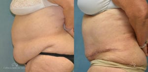 Panniculectomy Before and After Photos Patient 5b