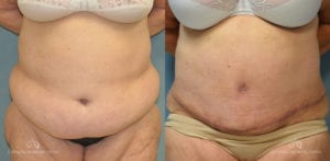 Panniculectomy Before and After Photos Patient 5C