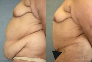 Patient 7 Panniculectomy Before and After Left Side View
