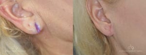 Earlobe Repair Before and After Photos Patient 1B