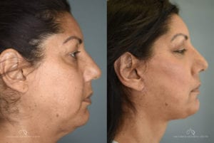 Patient 2 Face Lift Before and After Right Side View