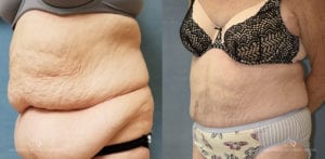 Patient 6 Panniculectomy Before and After Left Oblique View