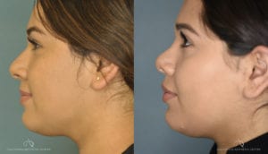 Patient 1 Rhinoplasty Before and After Left Side View