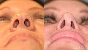Patient 2 Rhinoplasty Before and After Under