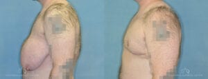 Patient 5 Gynecomastia Left Before and After