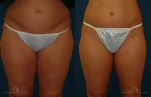 Patient 7 - Liposuction Before and After
